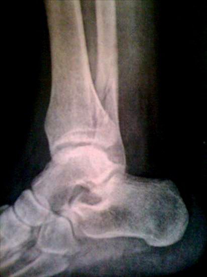 Broken Leg Collage Number One Broken Leg Collage Number One
